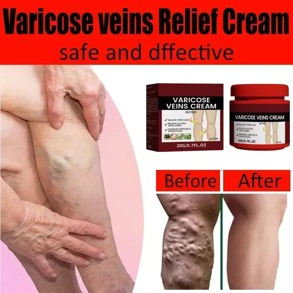 Ointment for Varicose Veins Effective Varicose Vein Relief Cream To Relieve Vasculitis Phlebitis Spider Pain Treatment Foot Care