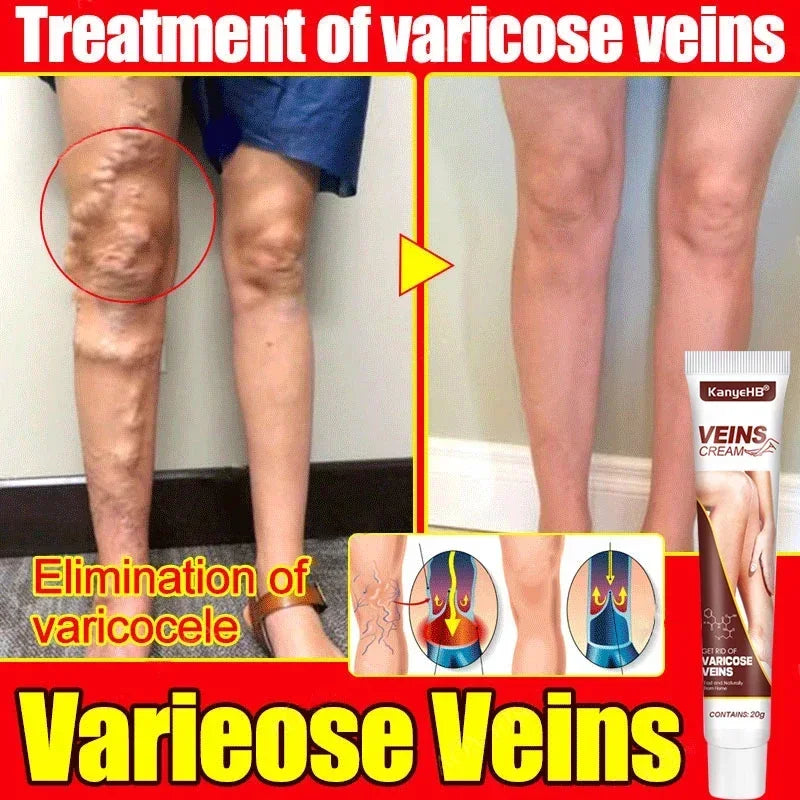 Effective Varicose Vein Relief Cream Ointment For Varicose Veins To Relieve Vasculitis Phlebitis Spider Pain Treatment