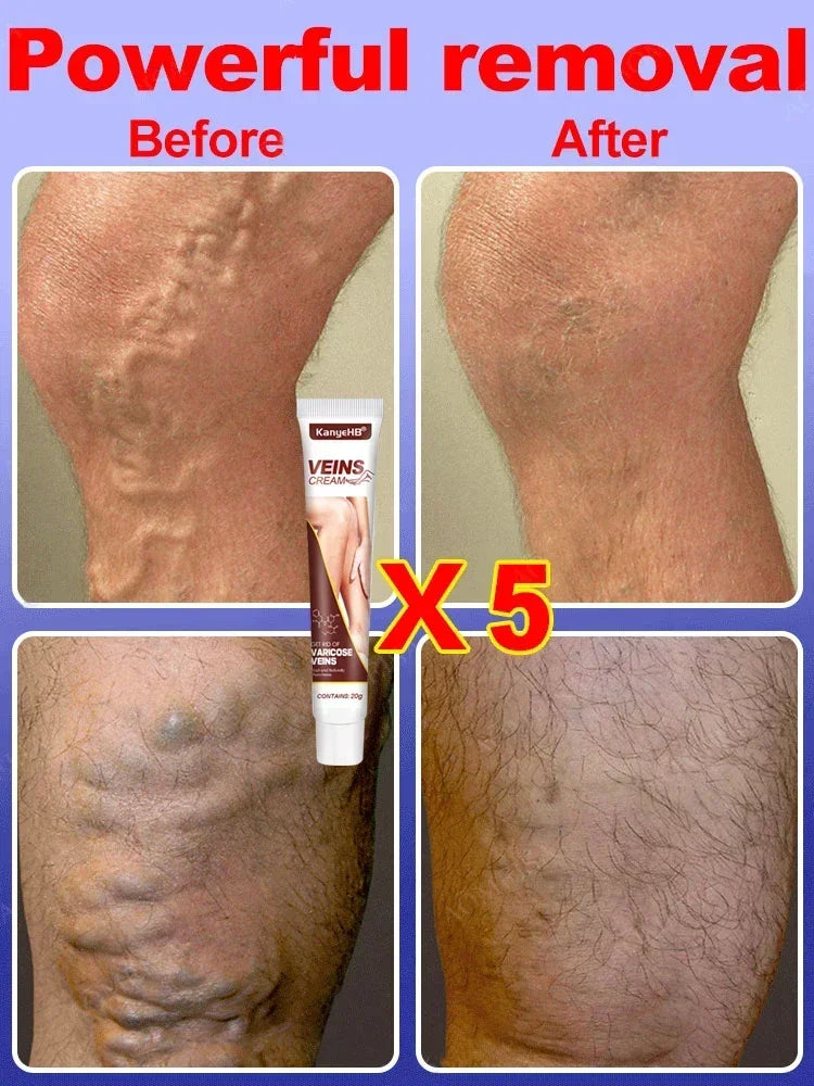 Effective Varicose Vein Relief Cream Ointment For Varicose Veins To Relieve Vasculitis Phlebitis Spider Pain Treatment